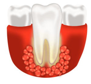 How to tell if you have a tooth abscess? 12 symptoms explained