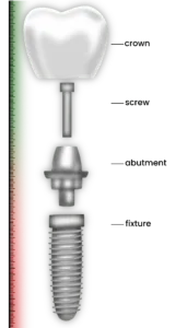 Bir dental implant düşerse ne yapılır: sizin için kısa bir rehber!