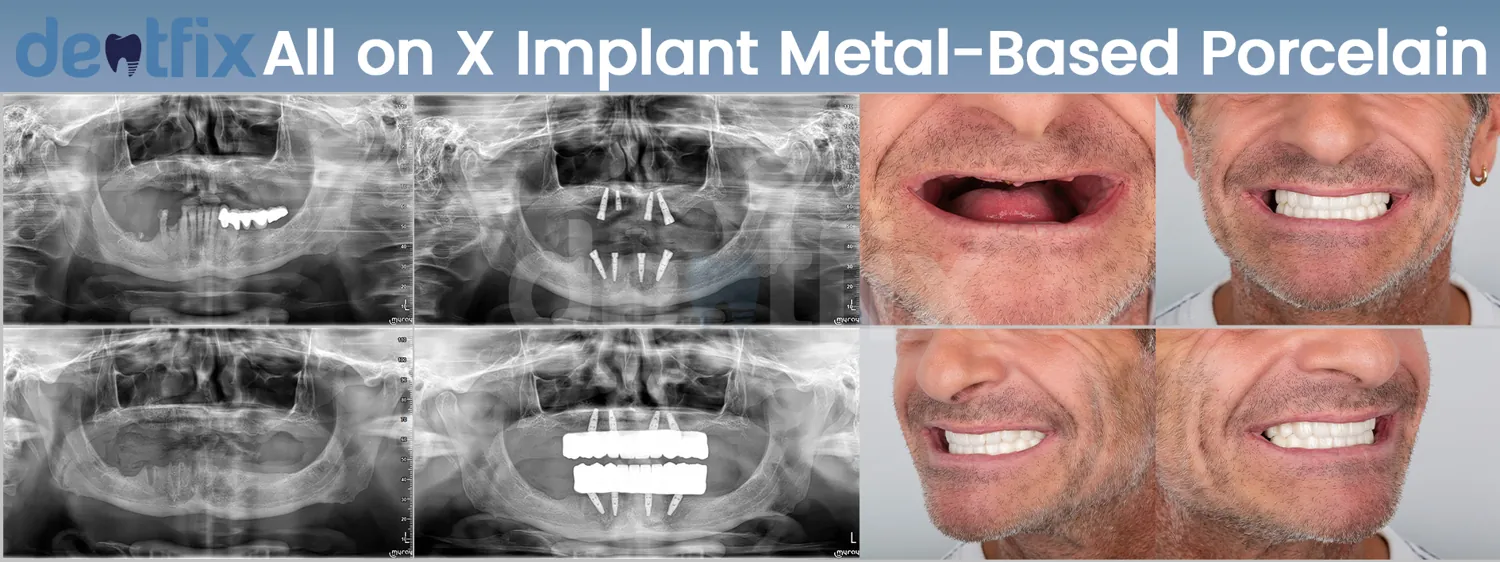 Dental implant cost, average prices, financing: what do you need to know?
