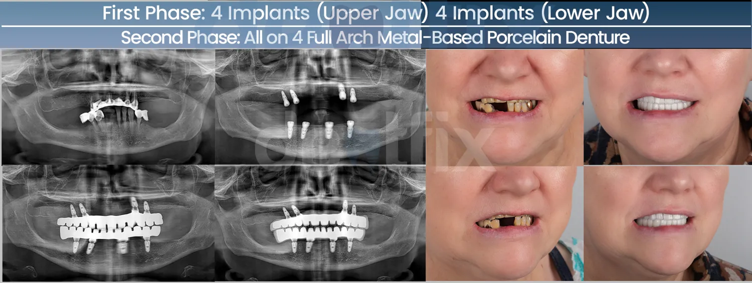 Holistic dental implants: what is it, the benefits, and more explained!