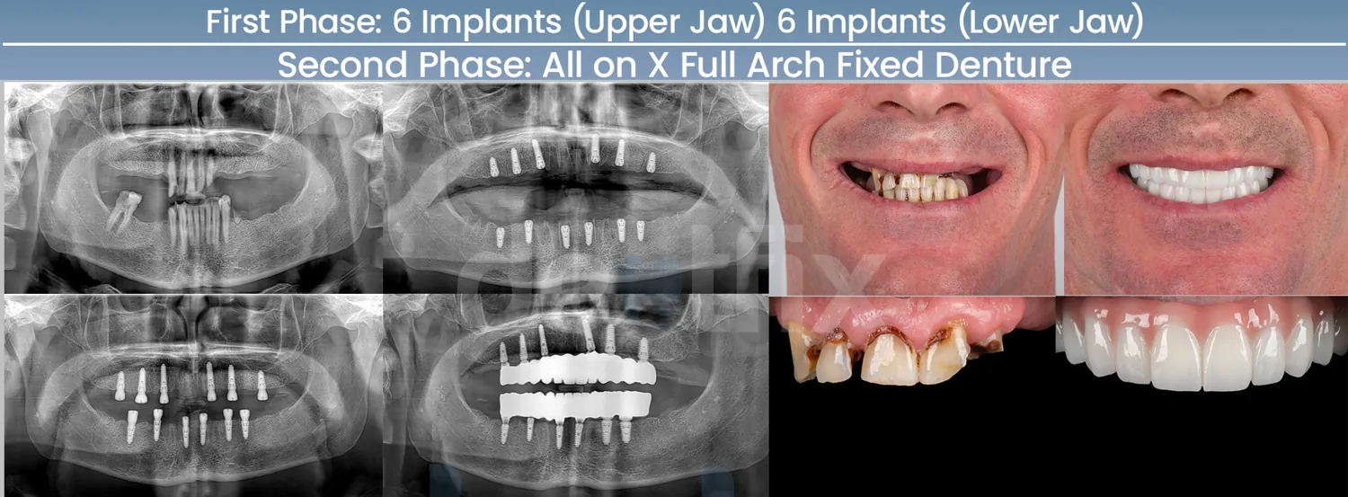 Dentures 101: everything you need to know about this treatment