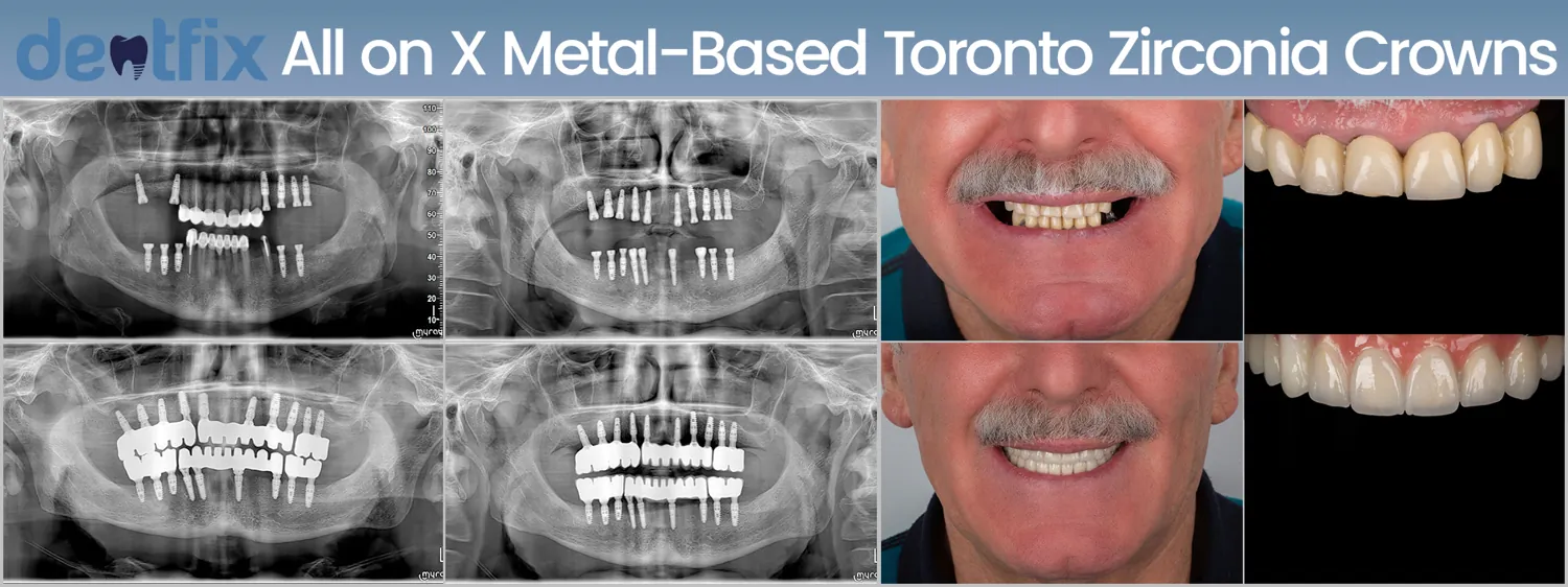 Dental implant treatment