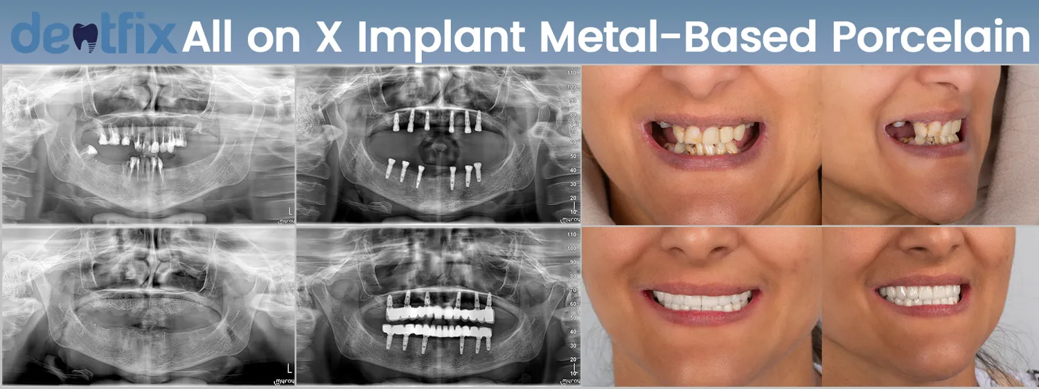 Bridges vs dental implants: Unveiling the perfect smile solution