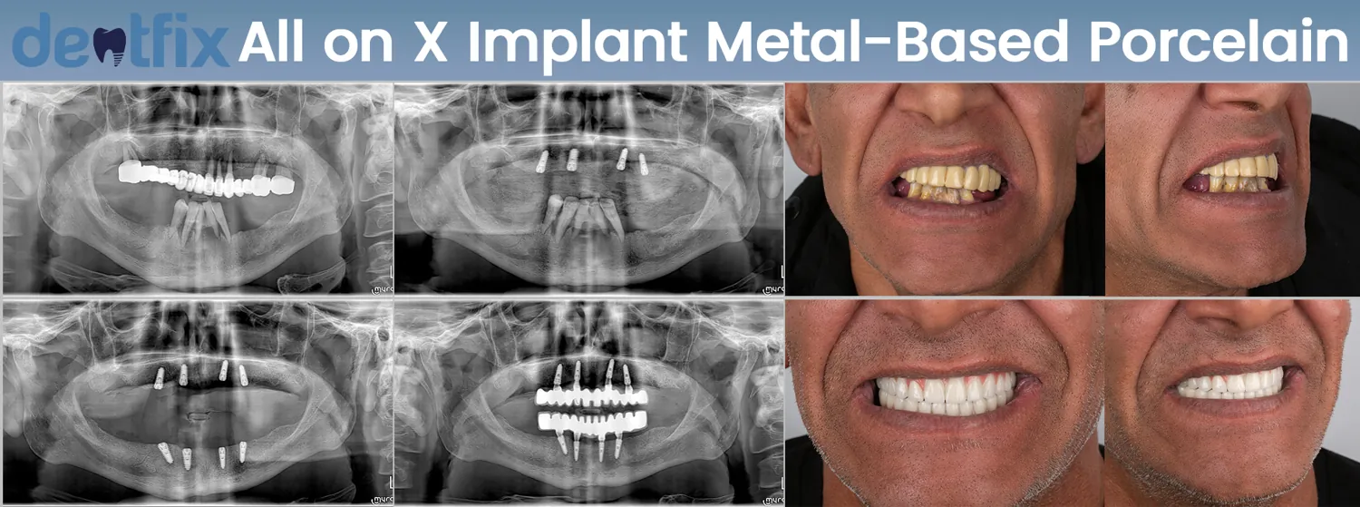 Can you get dental implants with periodontal disease? Yes or no?