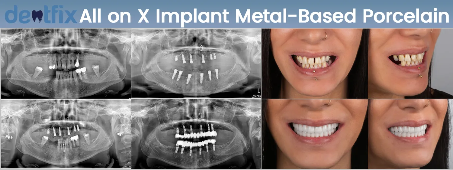 Dental implants infection: The battle between metals and germs