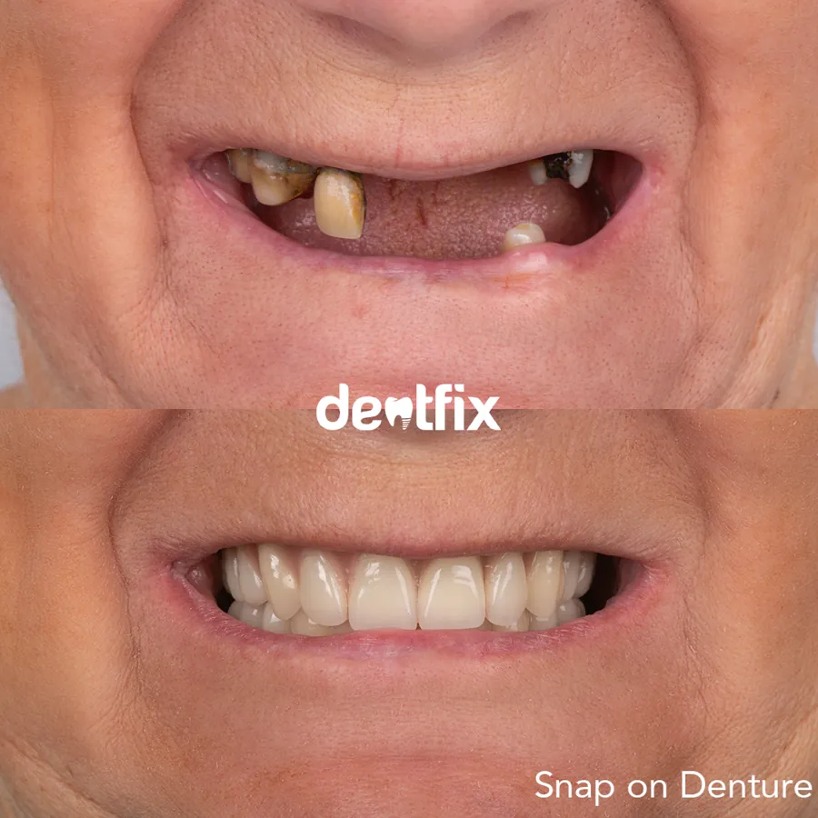 Teeth Whitening