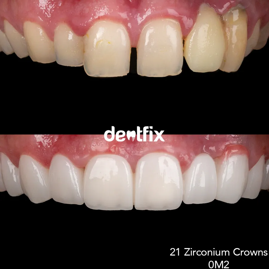 Veneers & E-max