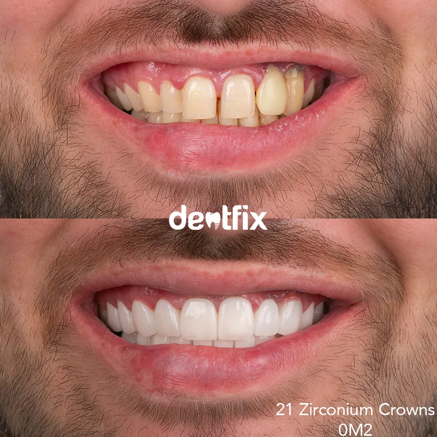 Affordable Clinics in Turkey for Full Veneers | 2025 Price Guide