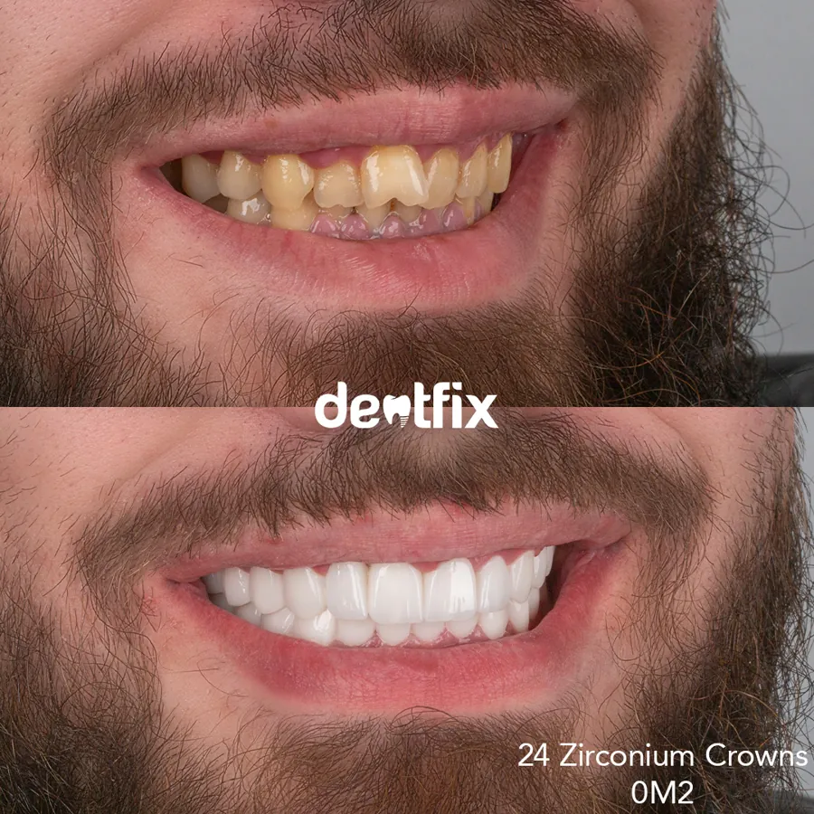 My teeth don’t show when I smile: Reasons and Treatments