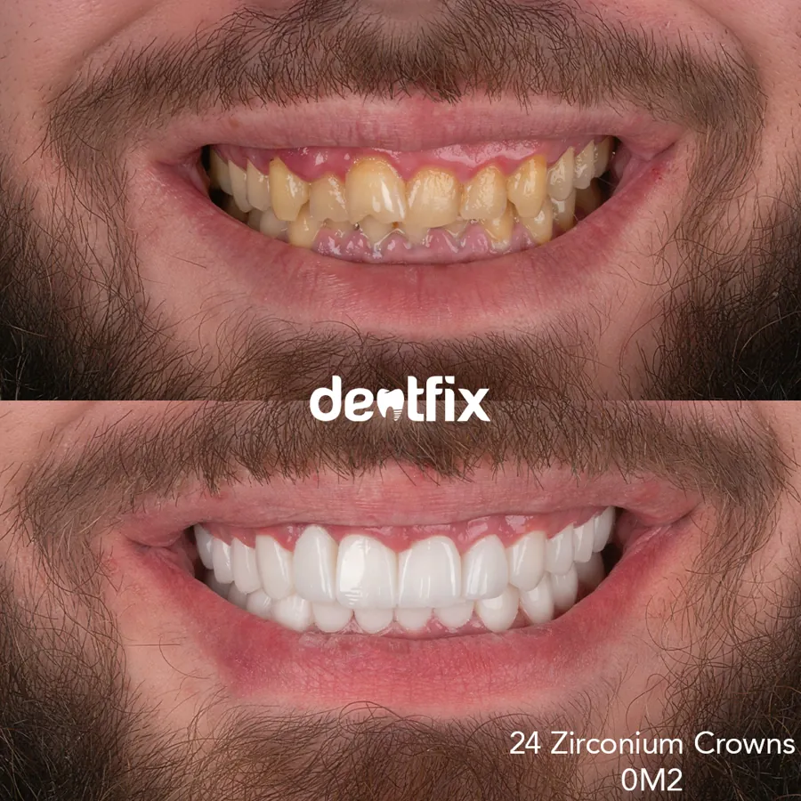 Hollywood Smile
