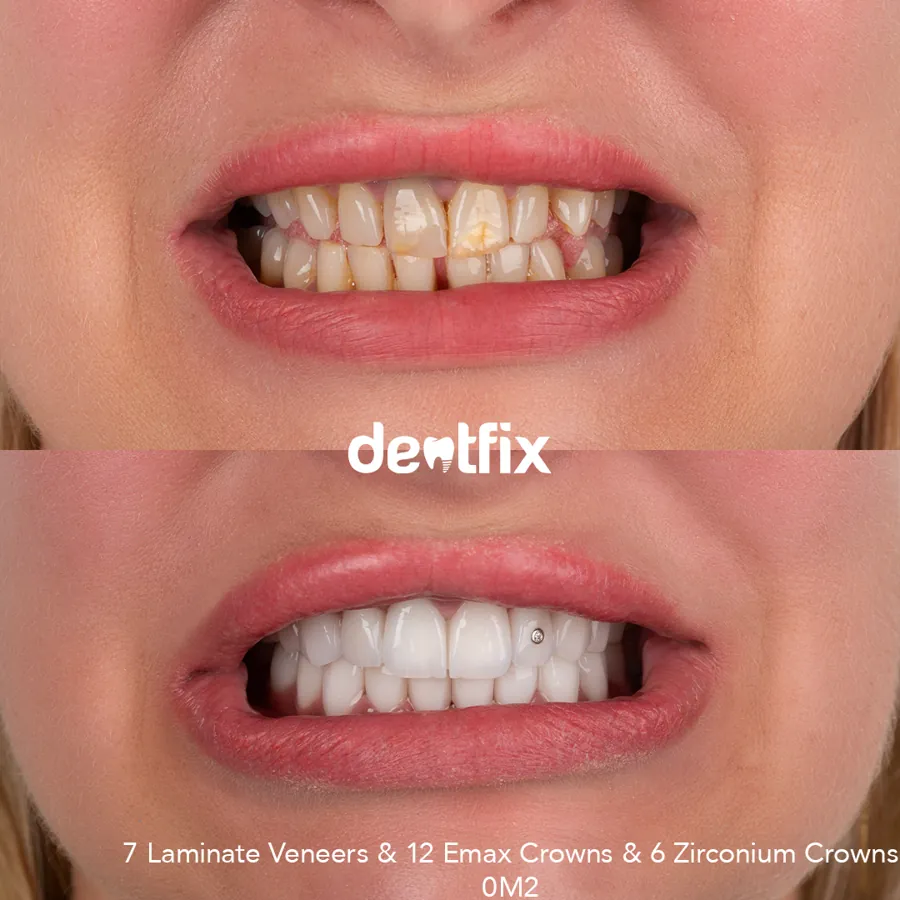 My teeth don’t show when I smile: Reasons and Treatments