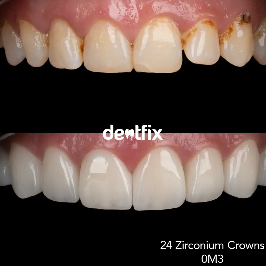 Dental treatment at Dentfix Clinic Istanbul