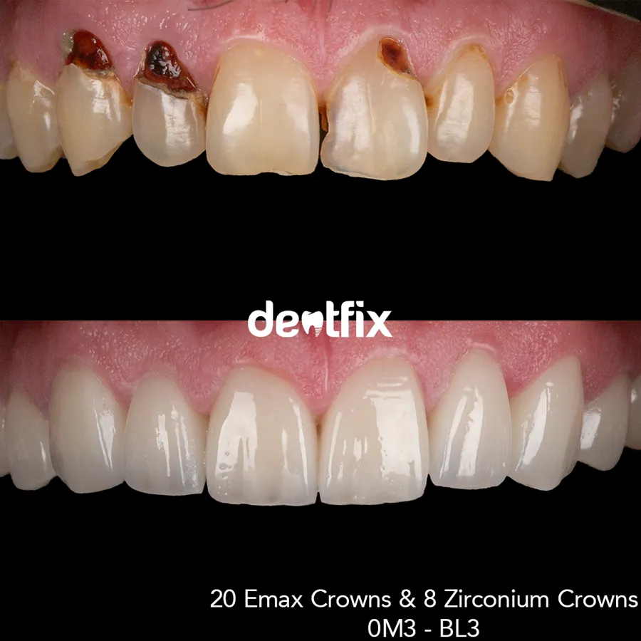 Dental crowns cost: what are the prices for every kind of crown?