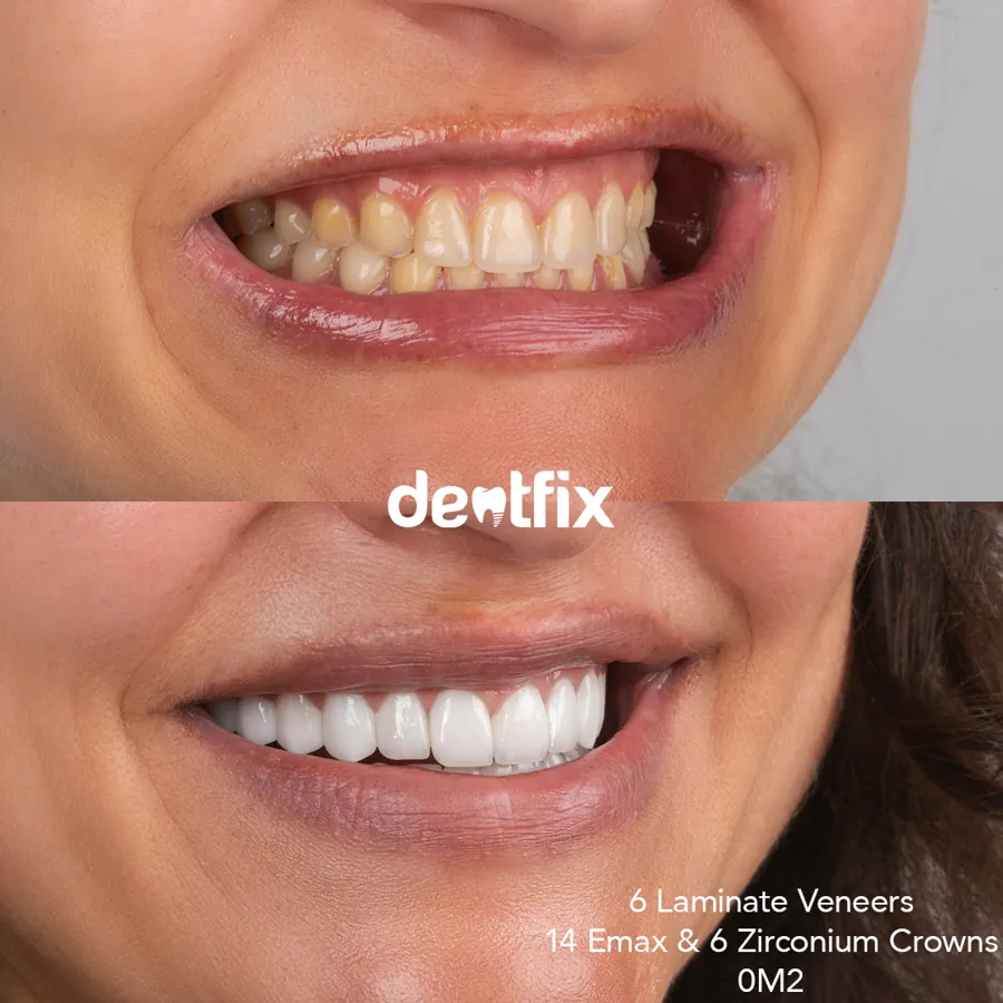 Zirconium Crowns