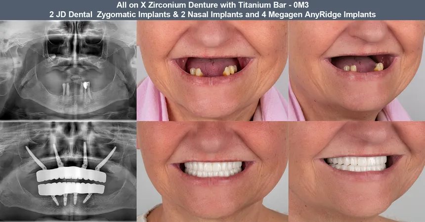 Zygomatic implants